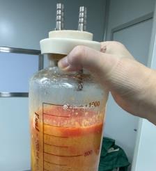 天门水动力吸脂手术要做多久？